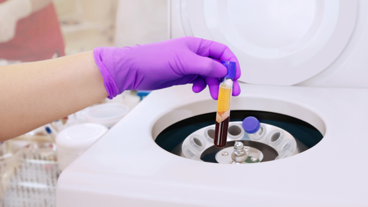 Platelet-Rich Plasma (PRP) Therapy