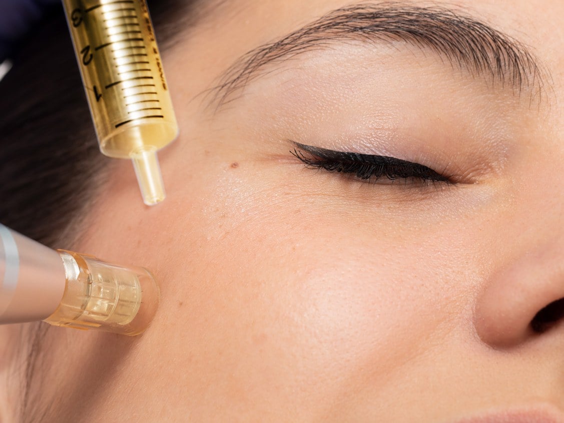PRP Facial at Precision Health & Wellness