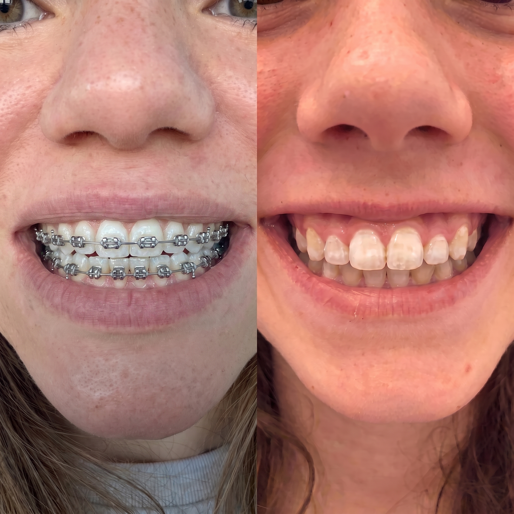 Before and After — 280 days of Bellarè use