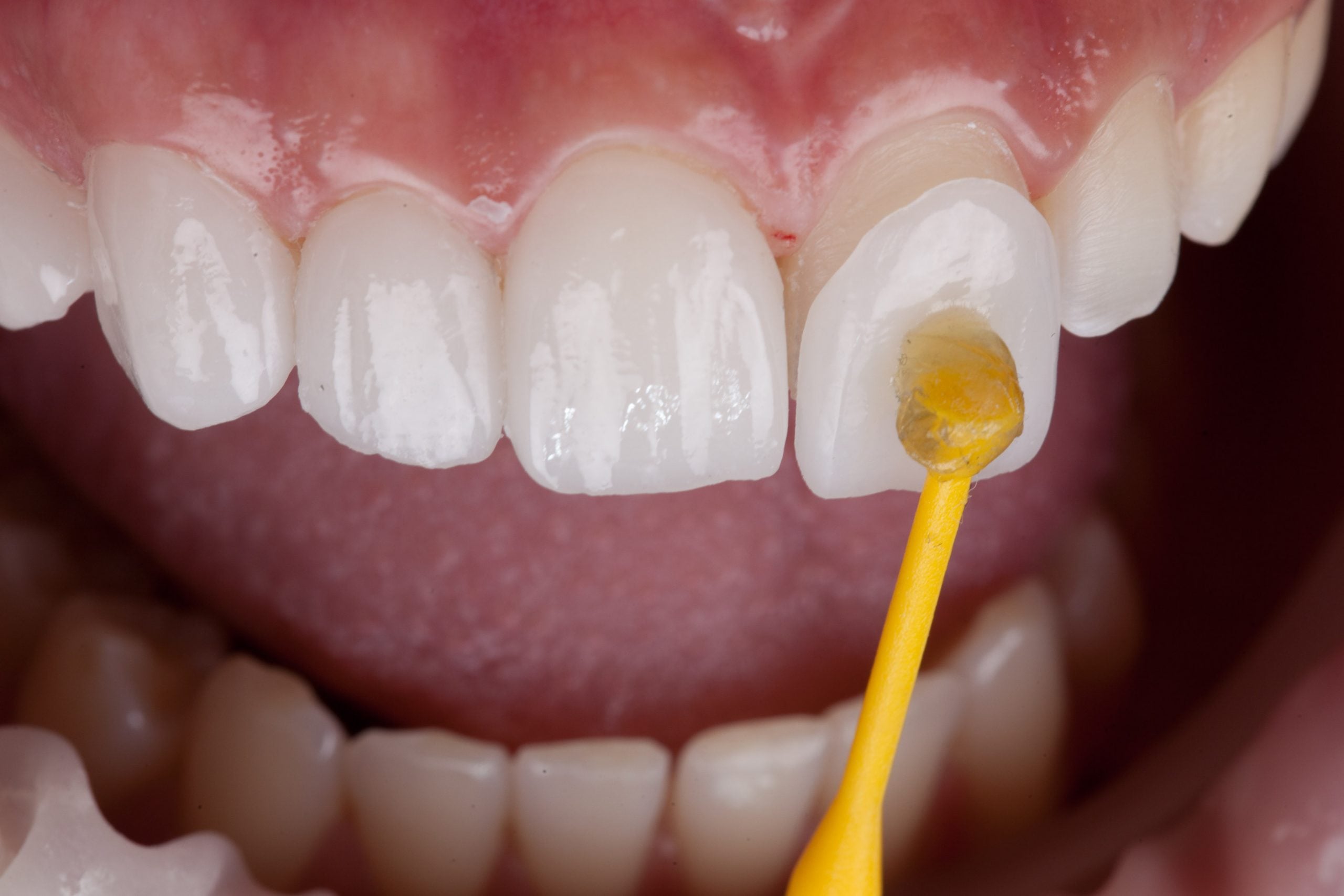 Porcelain Veneers at Yorkshire Smile Clinic