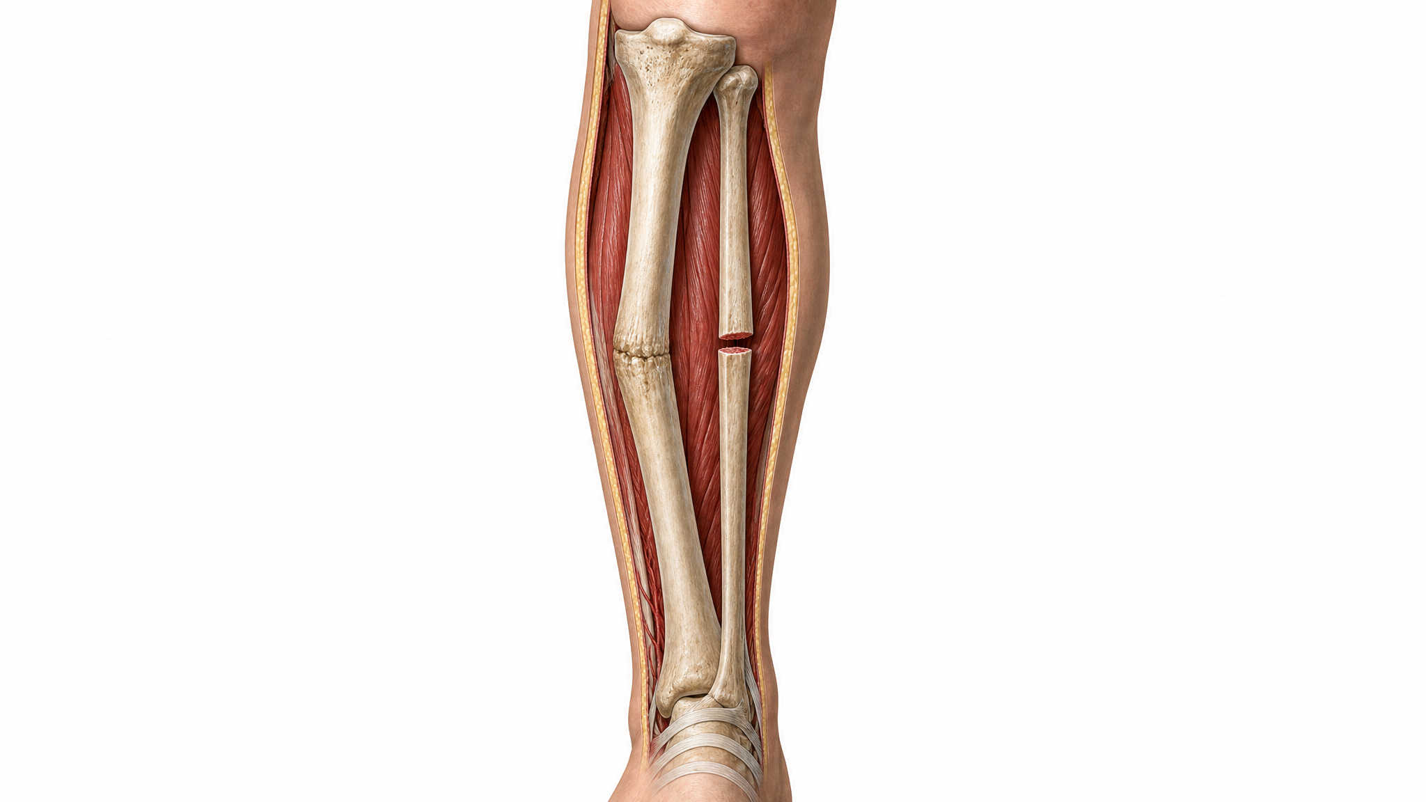 Medical illustration cutaway of a lower leg showing one bone healed crooked with angular deformity and a second bone with an un-healed gap between the ends