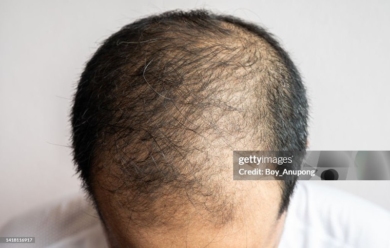 Tepe Bölgesi Tedavisi - Öncesi