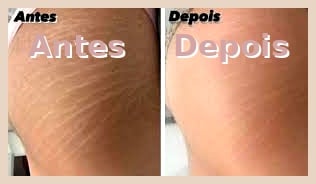 Transformação Pernas