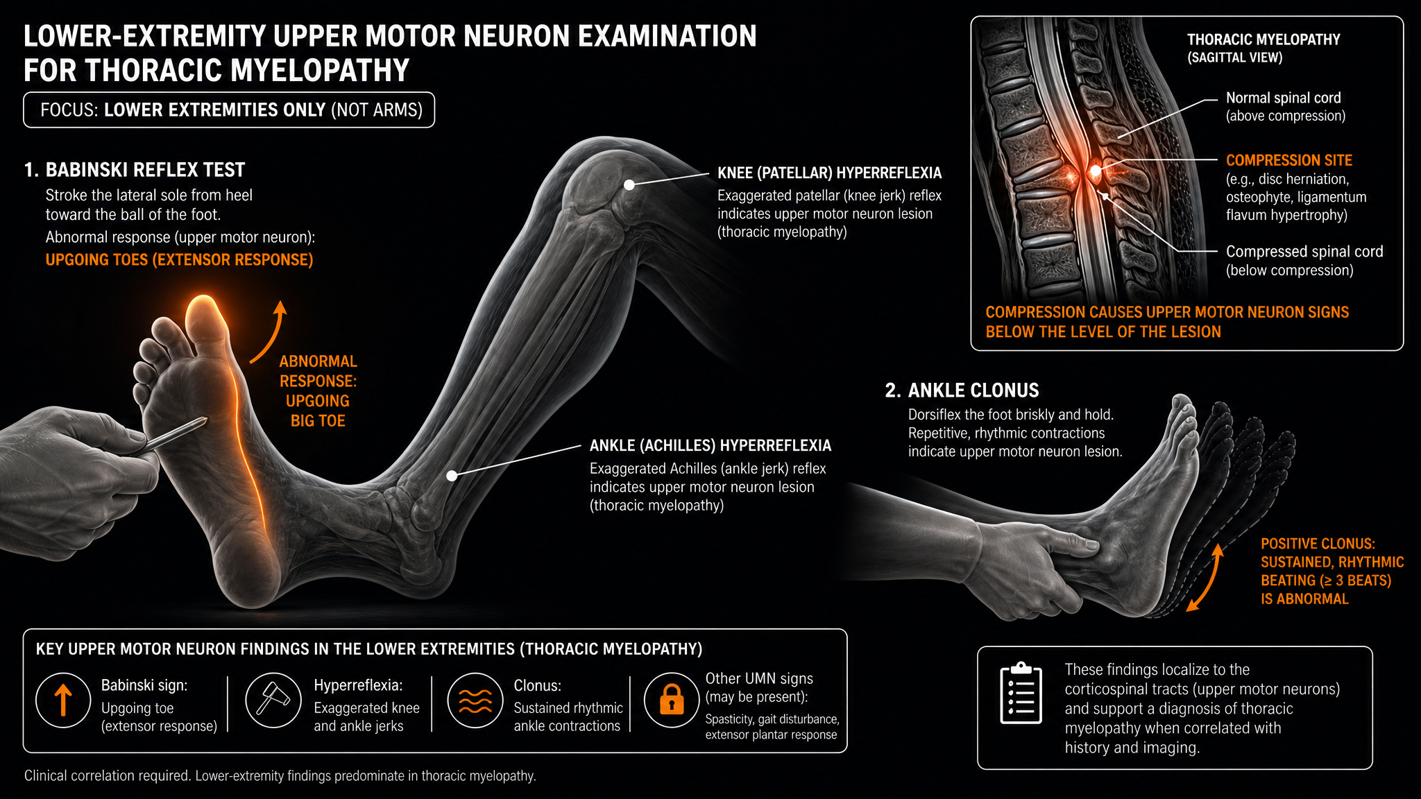 Dark labeled teaching diagram of the lower-extremity upper-motor-neuron exam, showing the Babinski response, ankle clonus, and an inset of the compressed thoracic cord