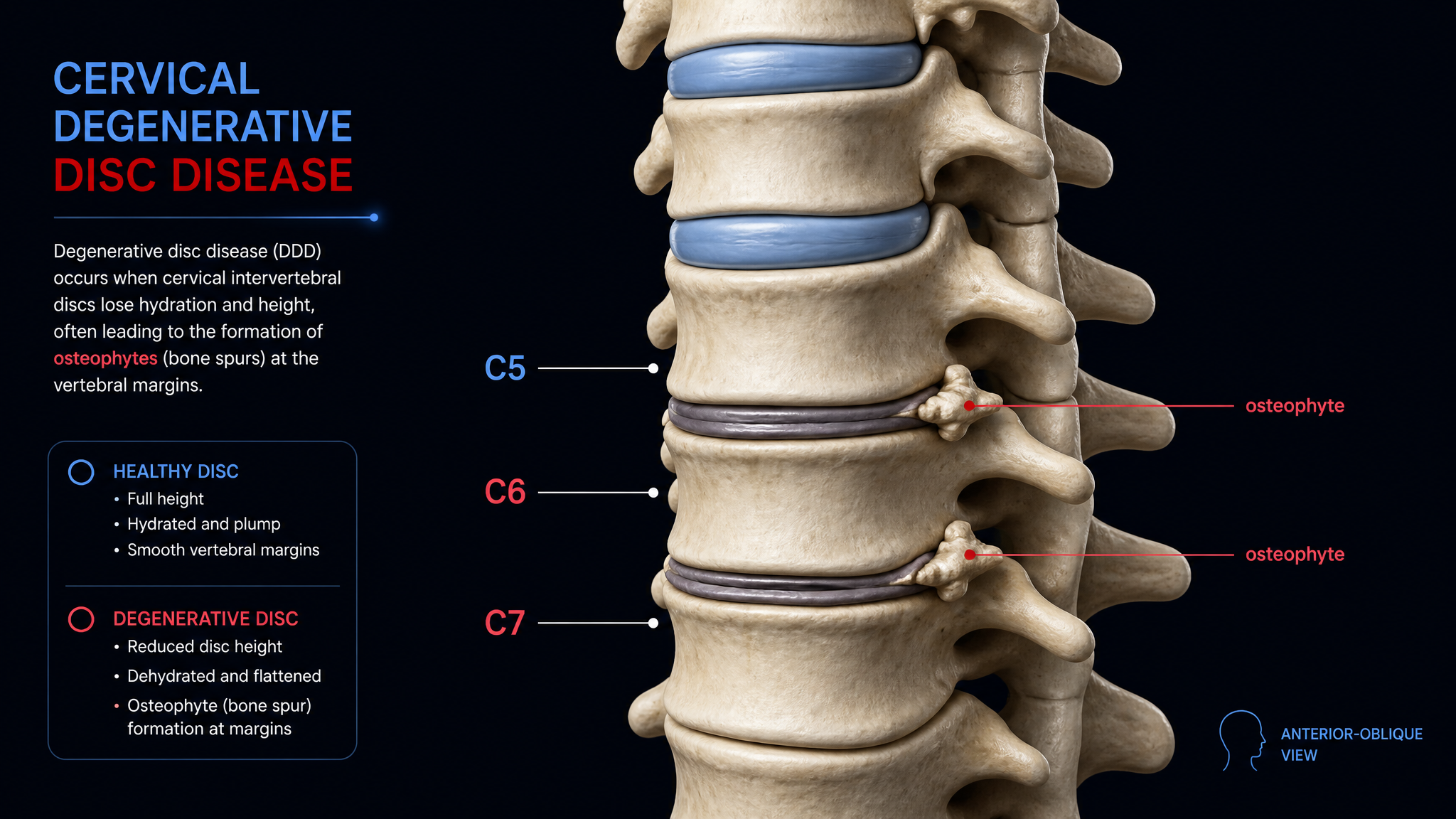 Cervical spine showing disc height loss and osteophytes