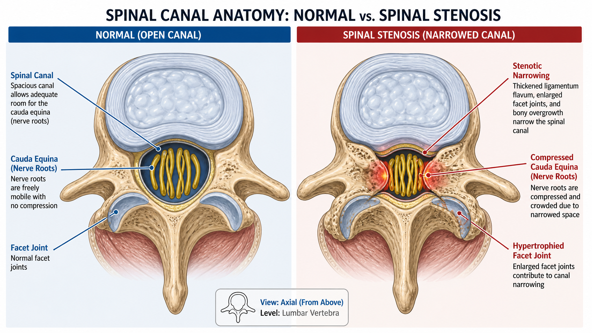 Cross-sectional anatomical illustration comparing a normal spinal canal with a stenotic narrowed canal compressing the cord and nerve roots