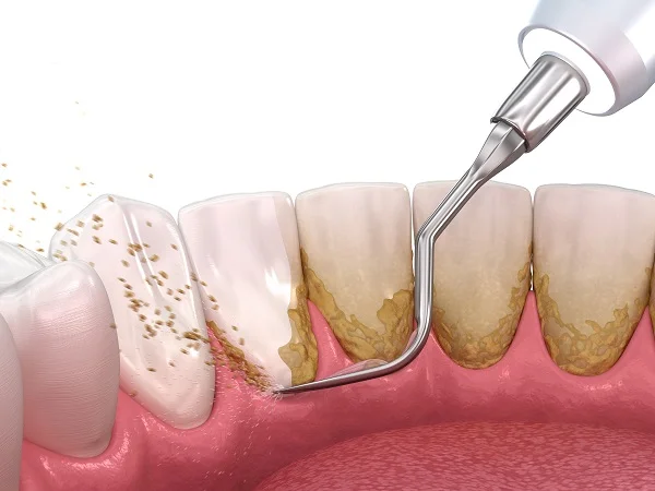 Limpeza e Prevenção
