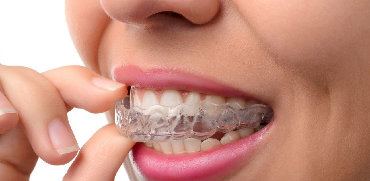 Invisalign at Yorkshire Smile Clinic