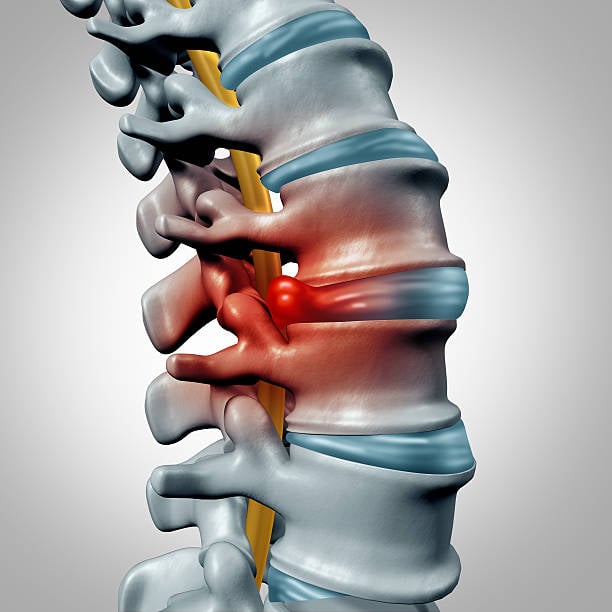 Herniated Discs