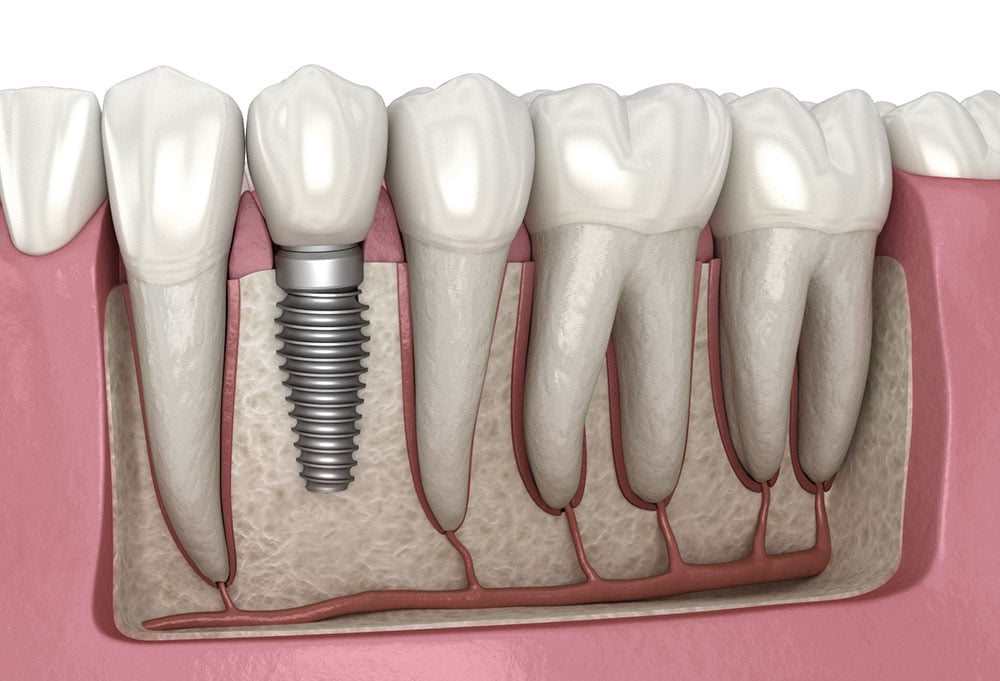 Dental Implants at Yorkshire Smile Clinic