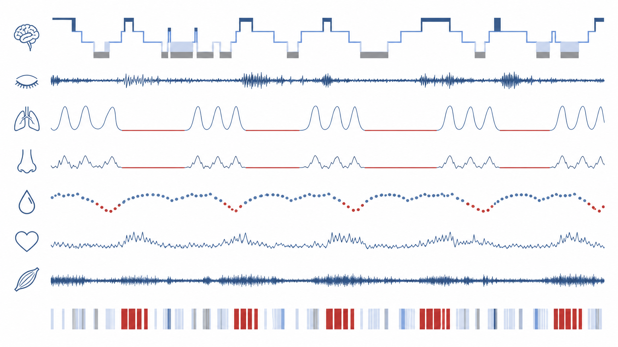 Medical illustration of a multi-channel polysomnography chart showing brain, breathing, oxygen and heart-rate traces with apnea events marked