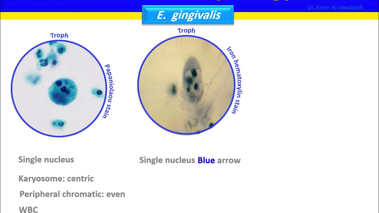 Gambaran mikroskopis trofozoit Entamoeba gingivalis dengan pseudopodia dan vakuola makanan berisi leukosit