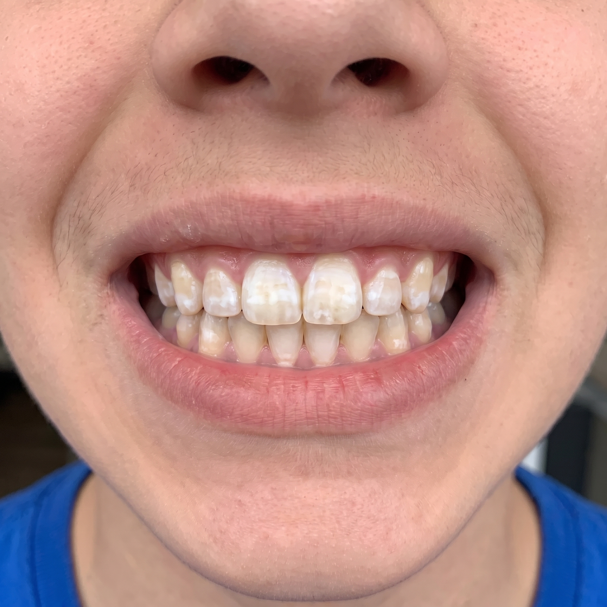 Before and After — 280 days of Bellarè use