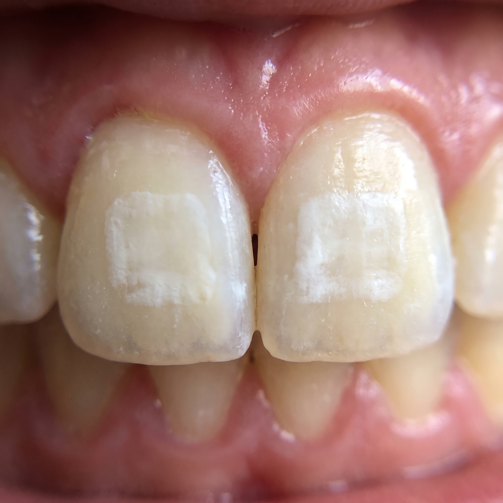 Before and After — 280 days of Bellarè use
