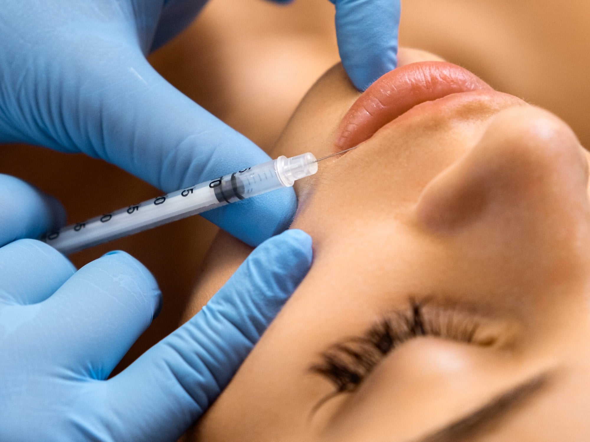 Sculptra Treatment at Precision Health & Wellness
