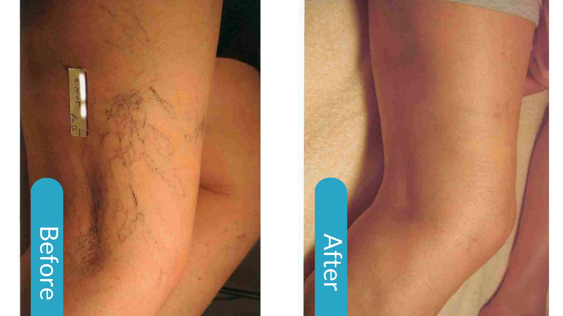 Vascular ND:YAG Laser at Born Beautiful Laser Clinic Calgary NW