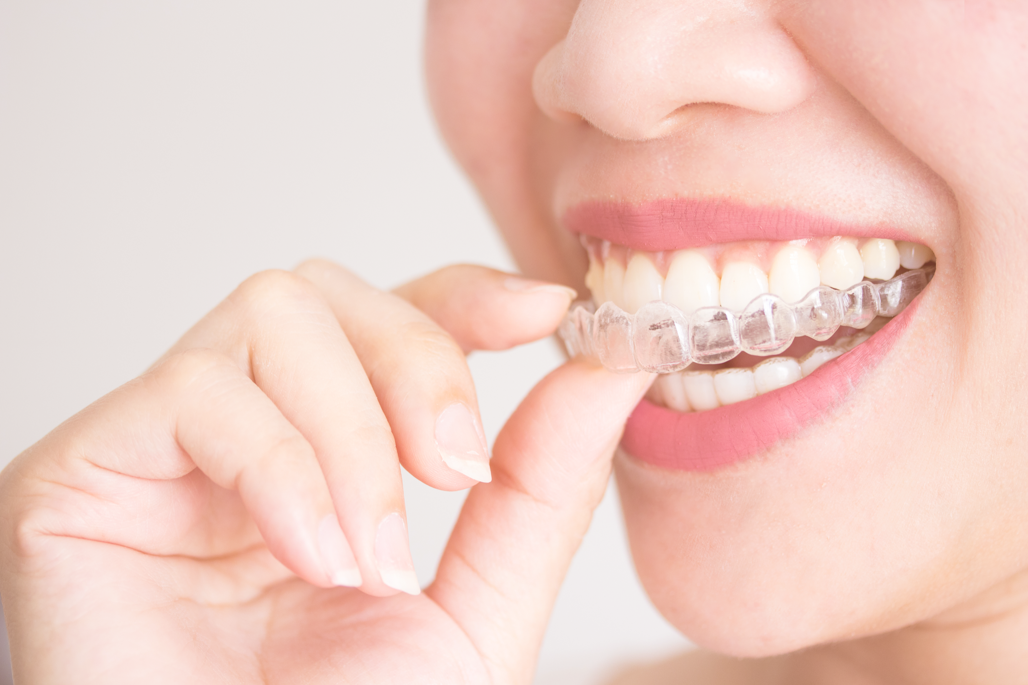 Invisalign Transformation