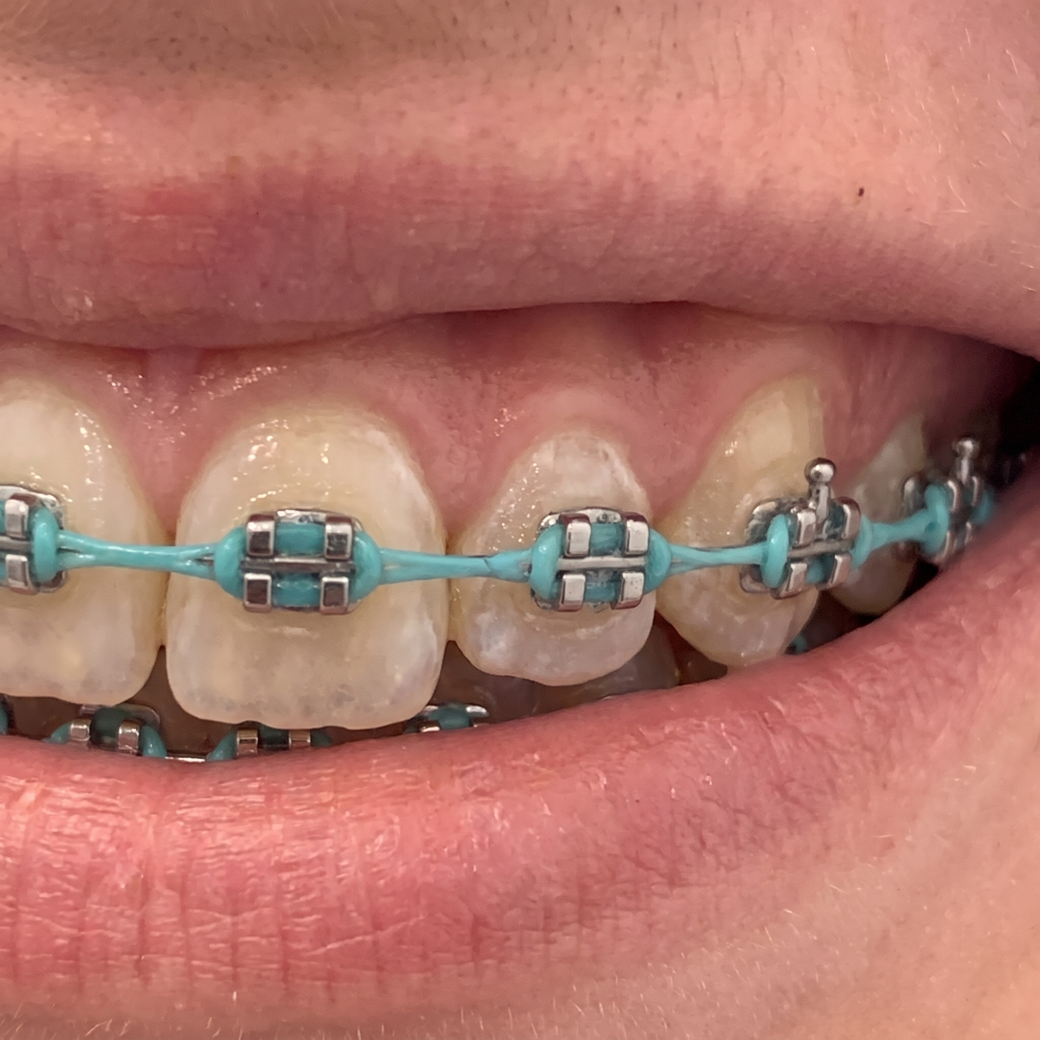 Before and After — 280 days of Bellarè use