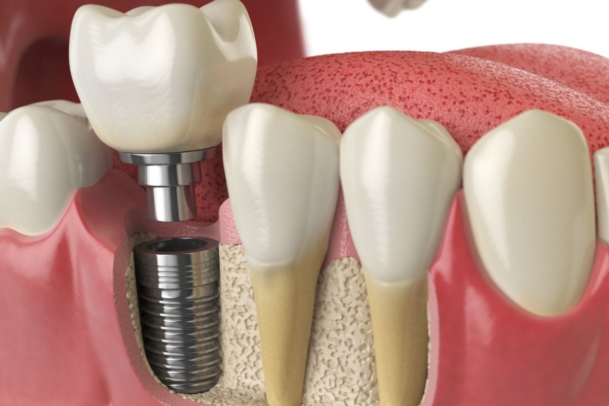 Dental implant procedure at Yorkshire Smile Clinic Harrogate