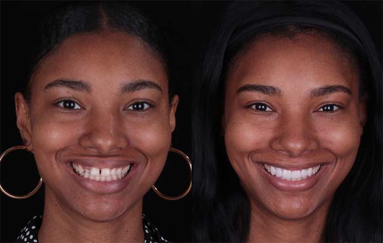 Smile makeover before and after transformation at Yorkshire Smile Clinic