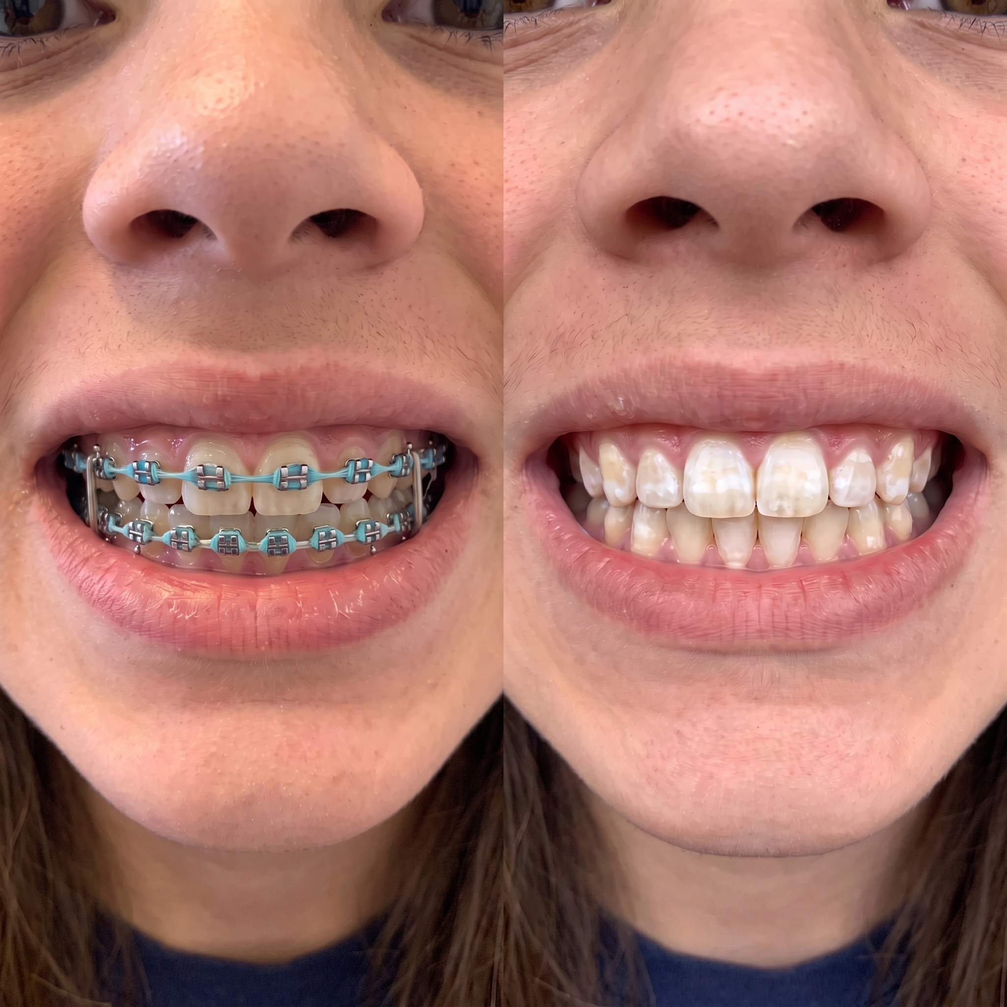 Before and After — 280 days of Bellarè use