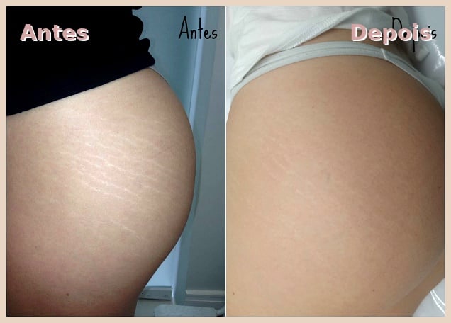 Transformação Glúteos