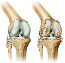 Osteocondrosis