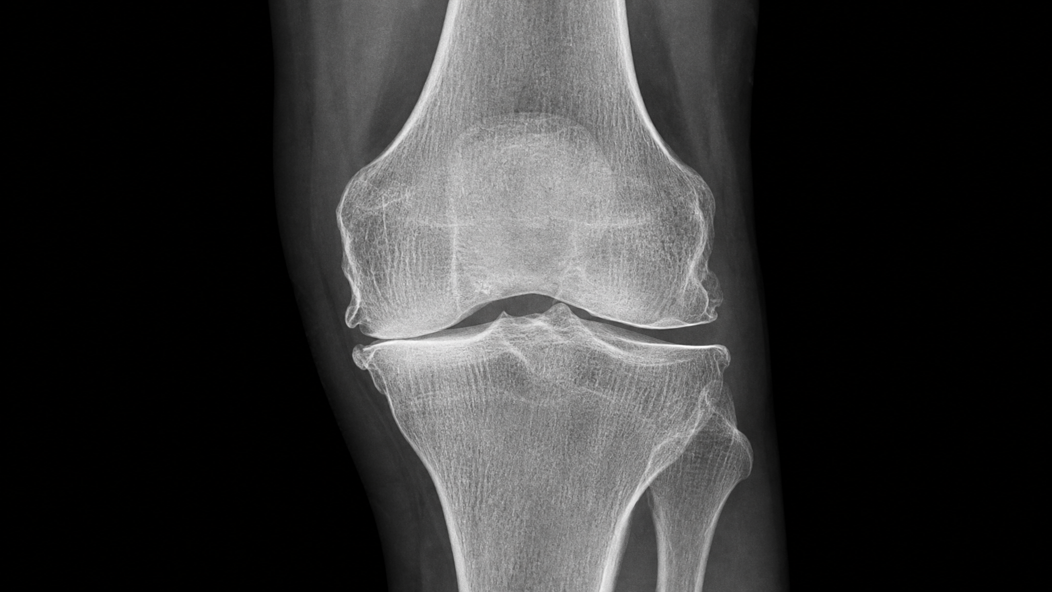 Knee X-ray showing joint-space narrowing, osteophytes, and subchondral sclerosis characteristic of osteoarthritis