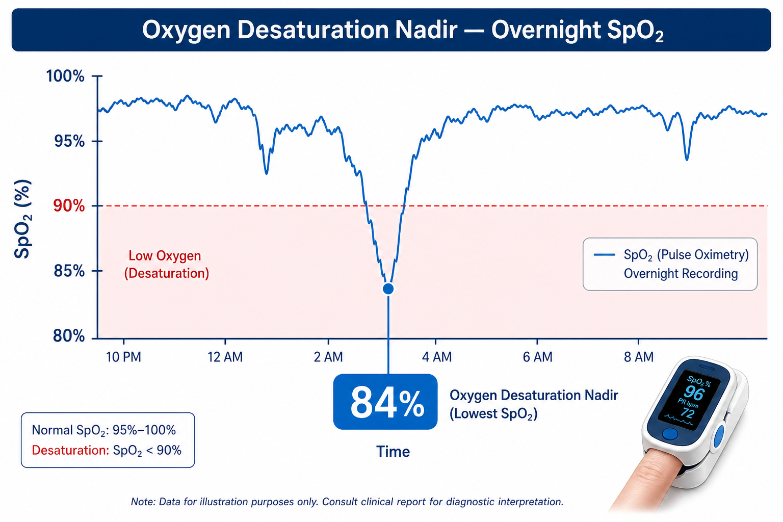 Clinical measurement diagram of overnight blood-oxygen saturation showing a pulse-oximetry trace dipping into a shaded low-oxygen zone with an 84 percent desaturation nadir callout