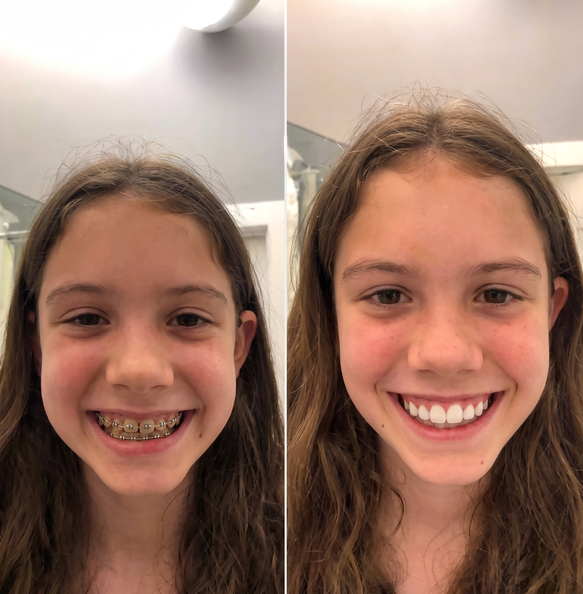Before and After — 280 days of Bellarè use