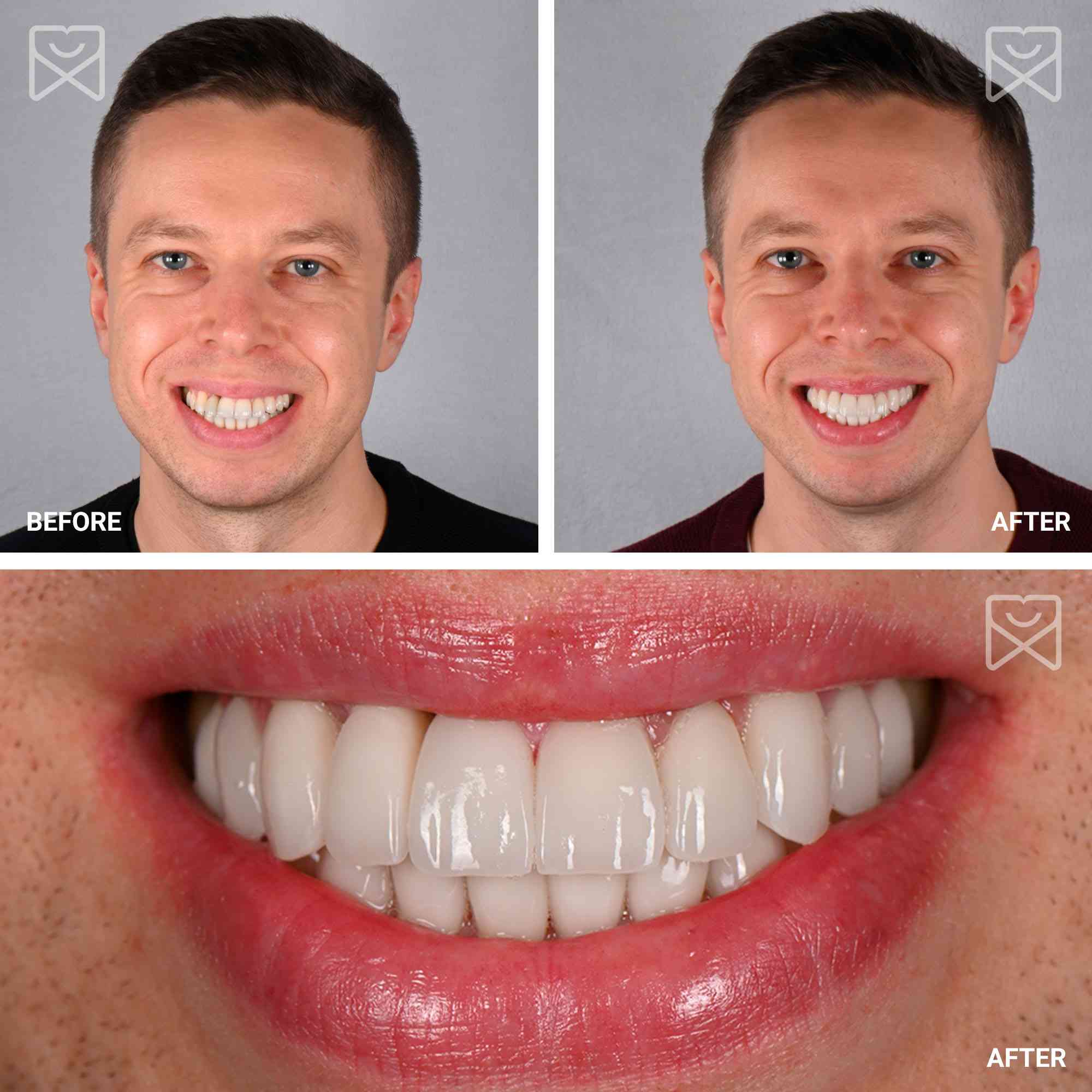 Smile Makeovers at Yorkshire Smile Clinic