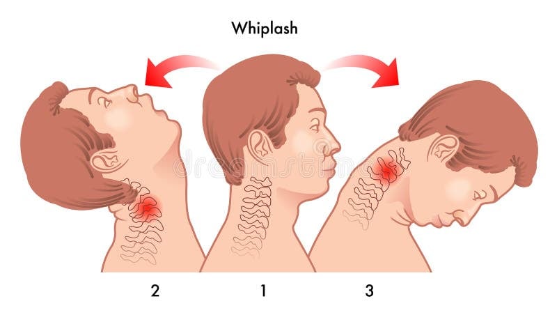 Whiplash Injuries