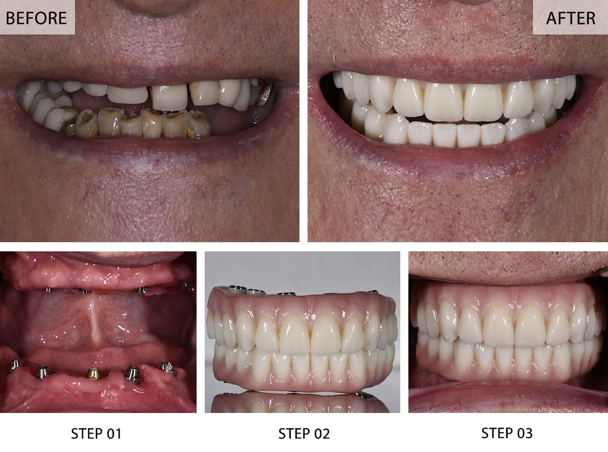 Implantes Dentários