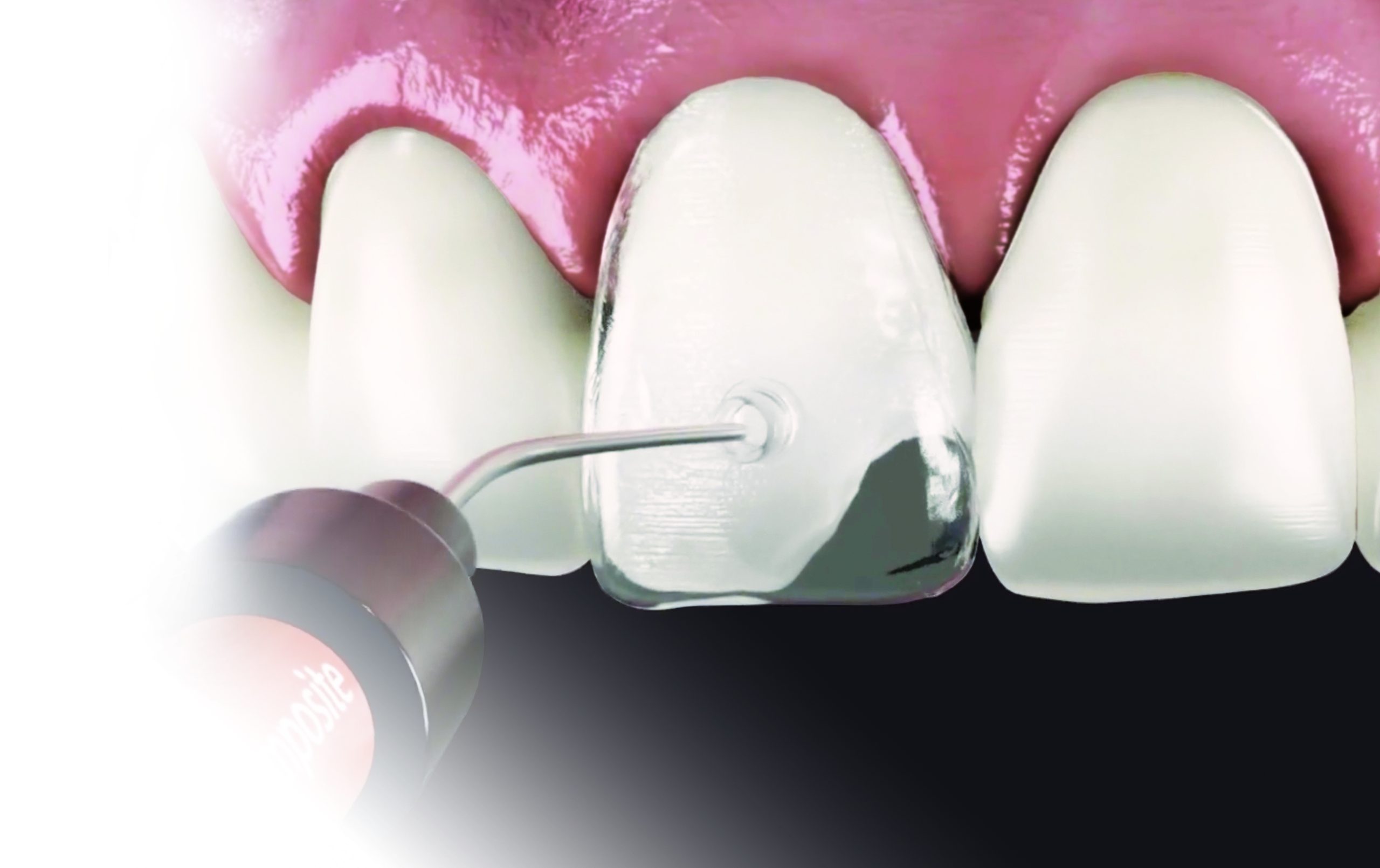 Porcelain veneer being carefully placed at Yorkshire Smile Clinic