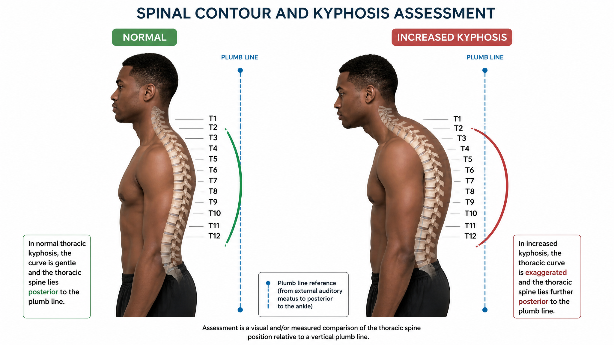 Labeled teaching diagram on a white background, side view, showing assessment of mid-back contour and increased kyphosis against a plumb line