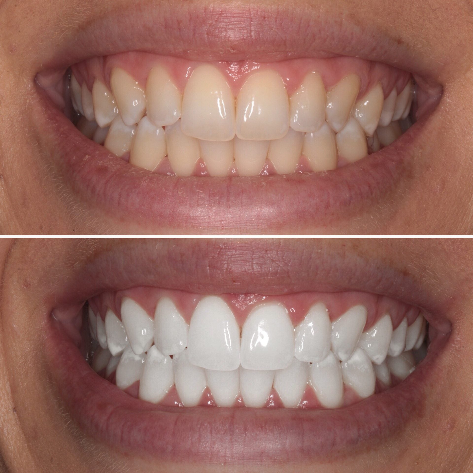 Teeth Whitening at Yorkshire Smile Clinic