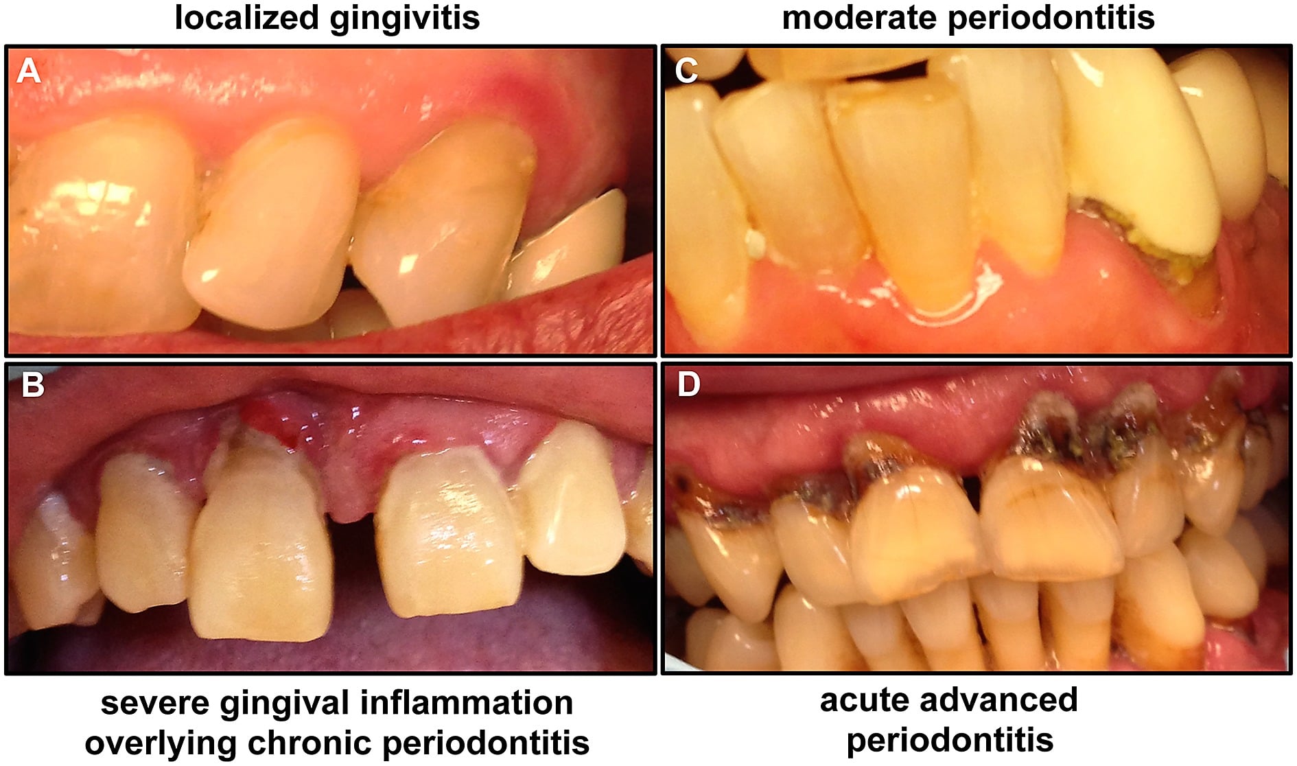 Penyakit periodontal yang berkaitan dengan infestasi parasit oral