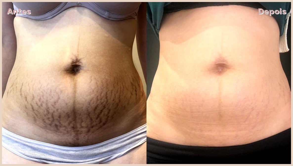 Transformação Abdômen