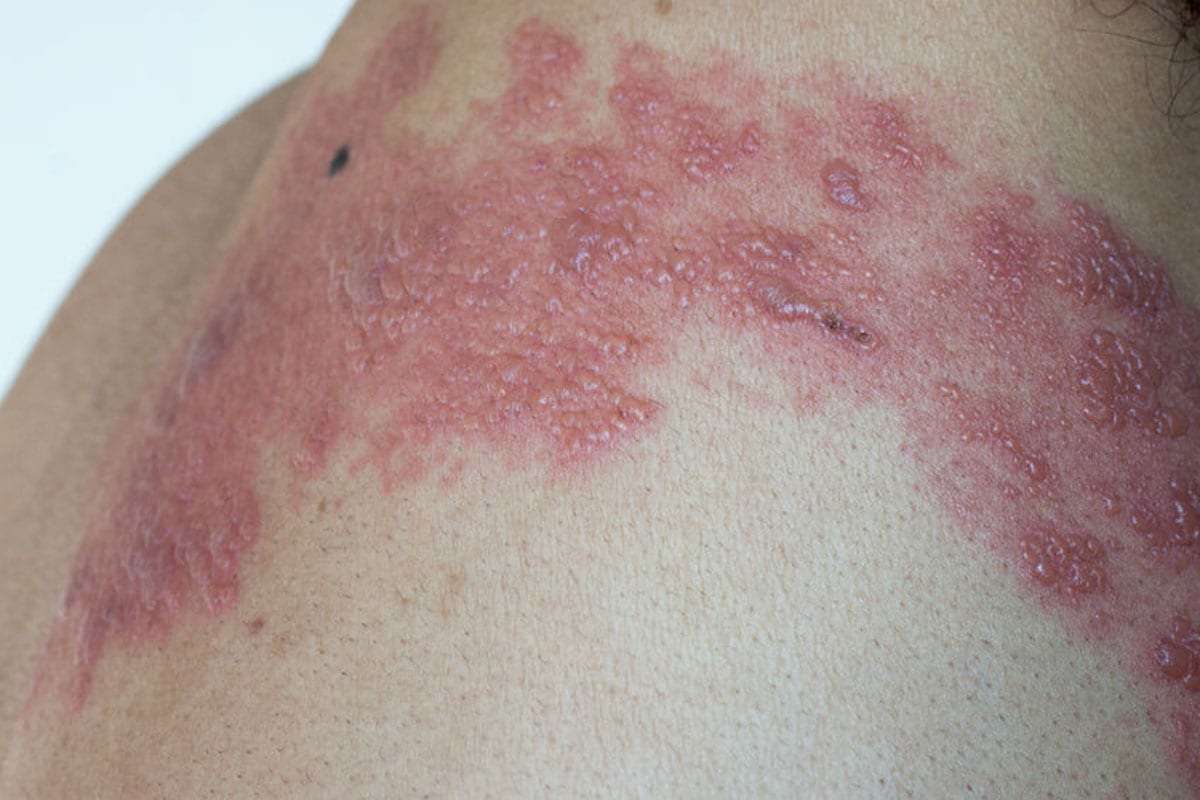 Shingles & Post-Herpetic Neuralgia