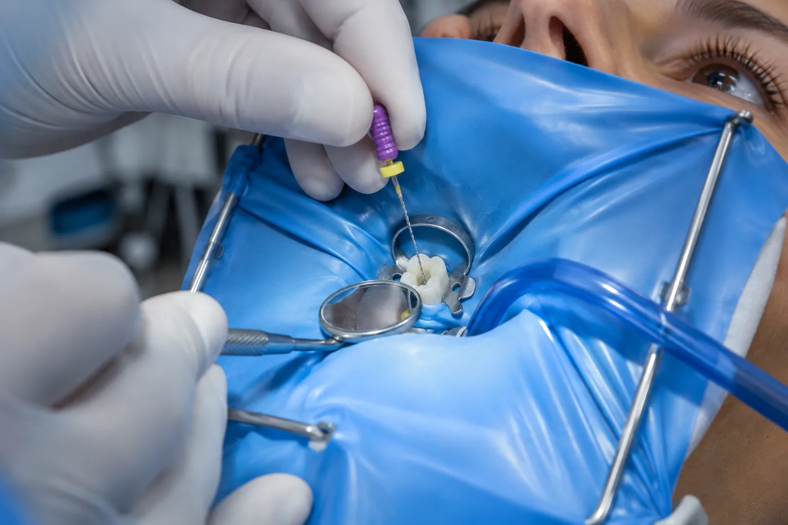 Root canal procedure being performed at our Fort Wayne emergency dental office