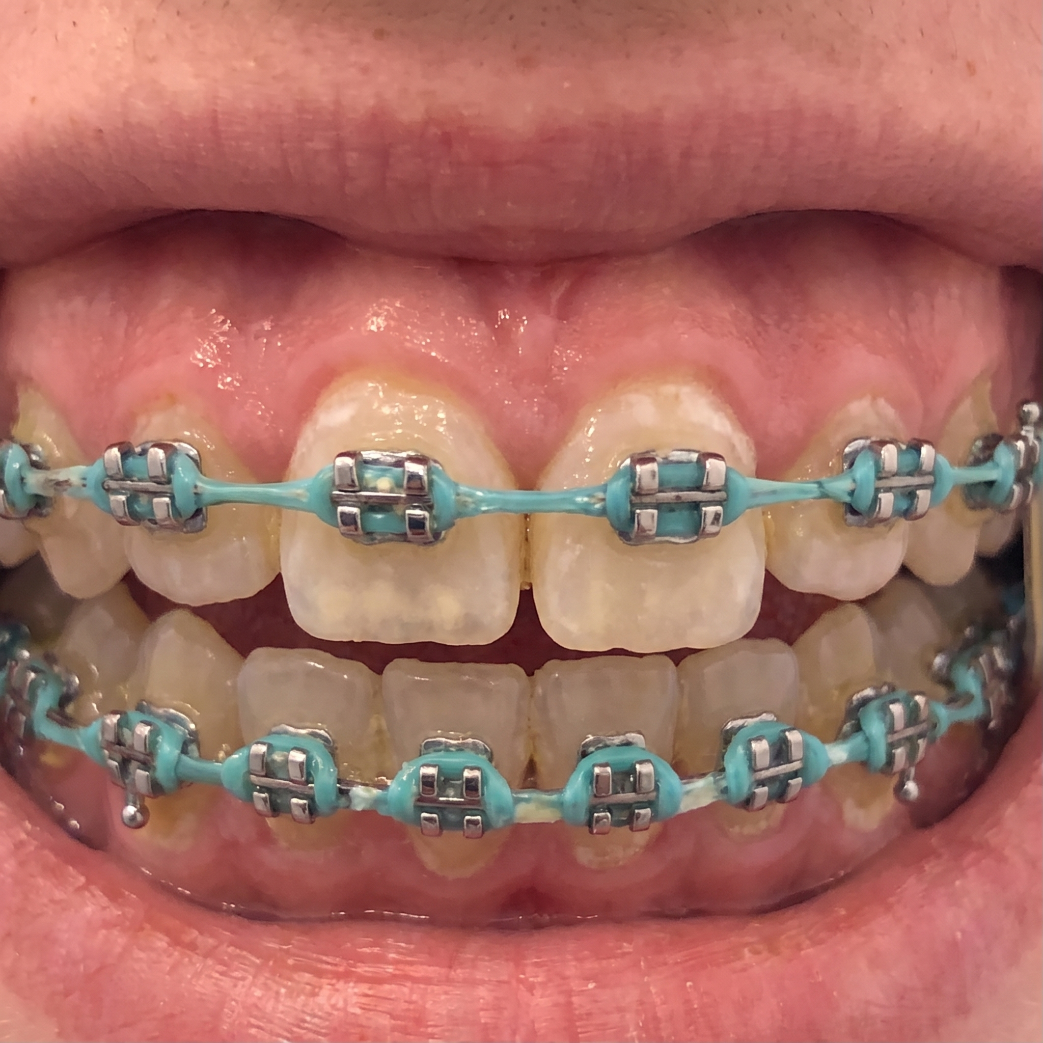 Before and After — 280 days of Bellarè use