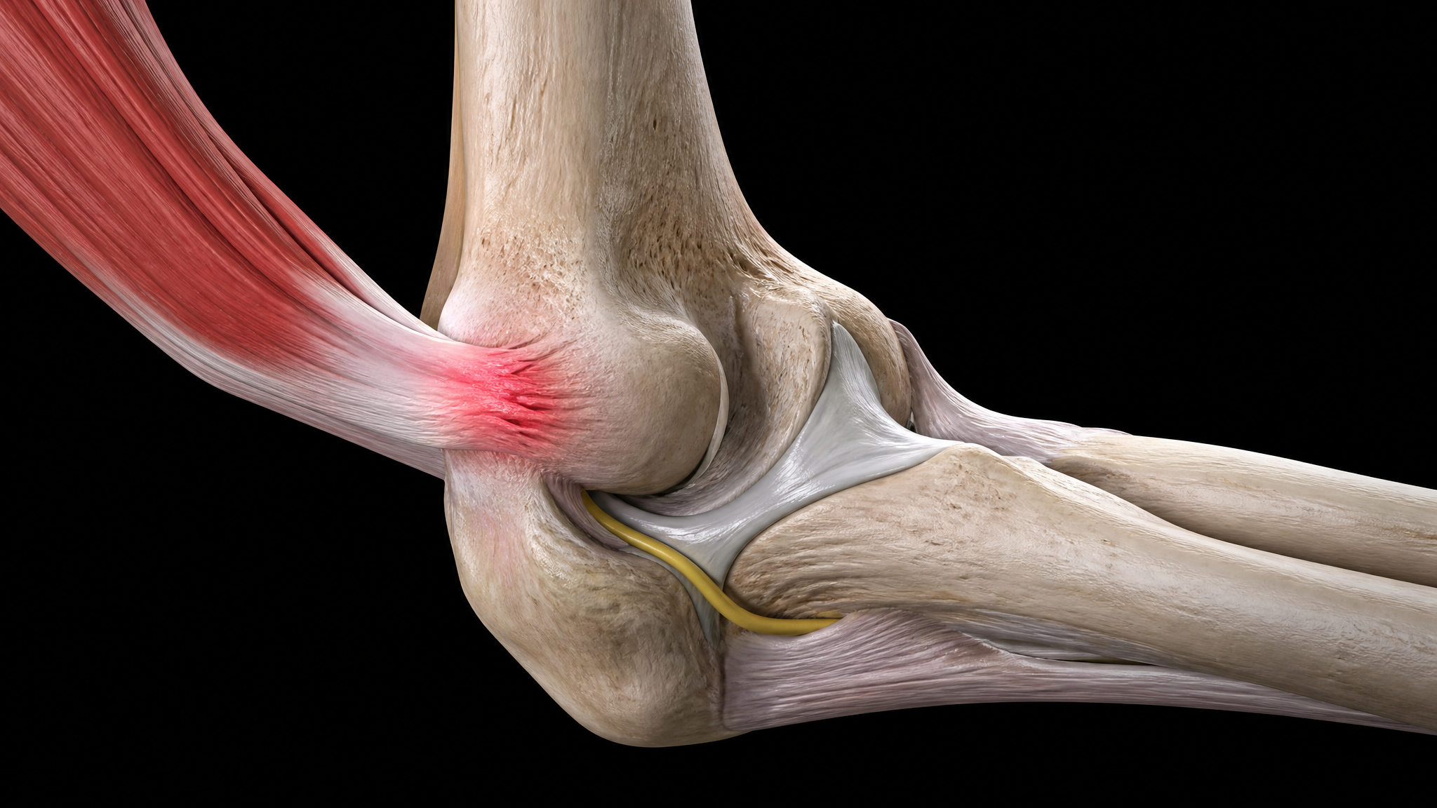 Detailed 3D anatomical render of a human elbow joint on a black background, showing the humerus, radius and ulna meeting at the elbow with the lateral epicondyle common extensor tendon origin highlighted in red indicating inflammation