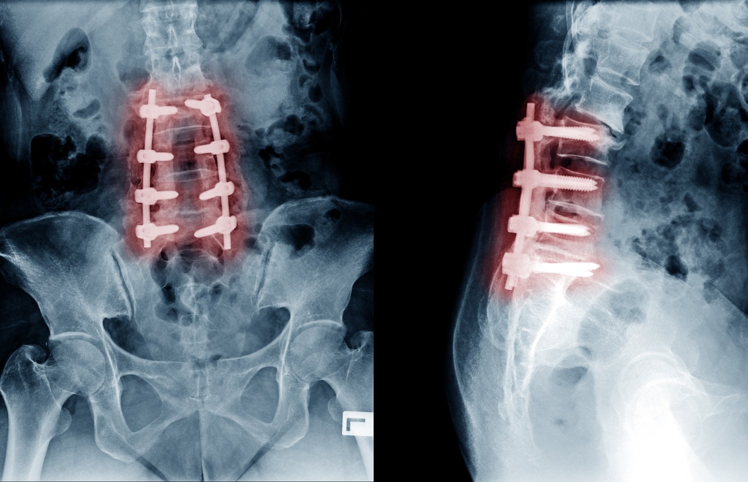 Post-Laminectomy Syndrome