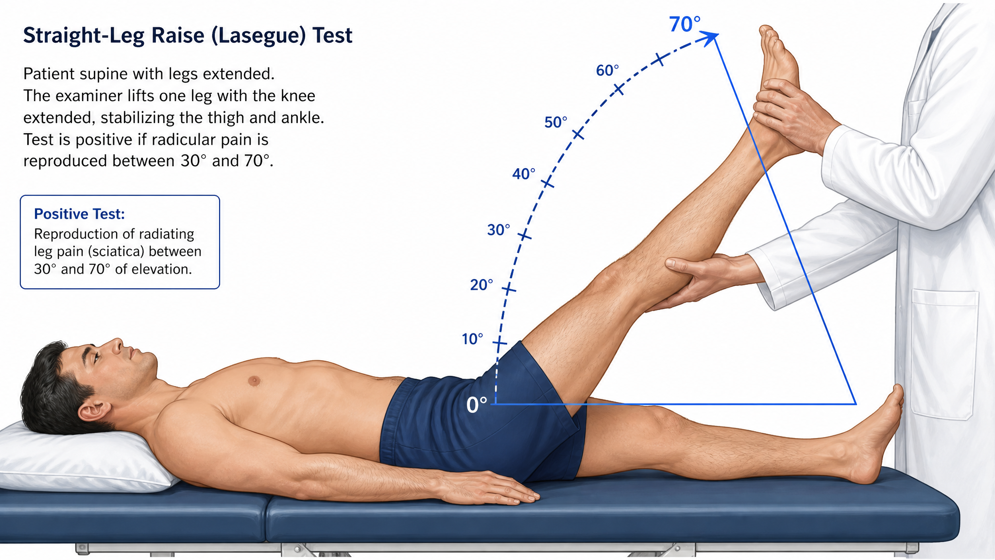 Clinical illustration of the straight leg raise test with the leg elevated and the angle of reproduction of radicular pain marked