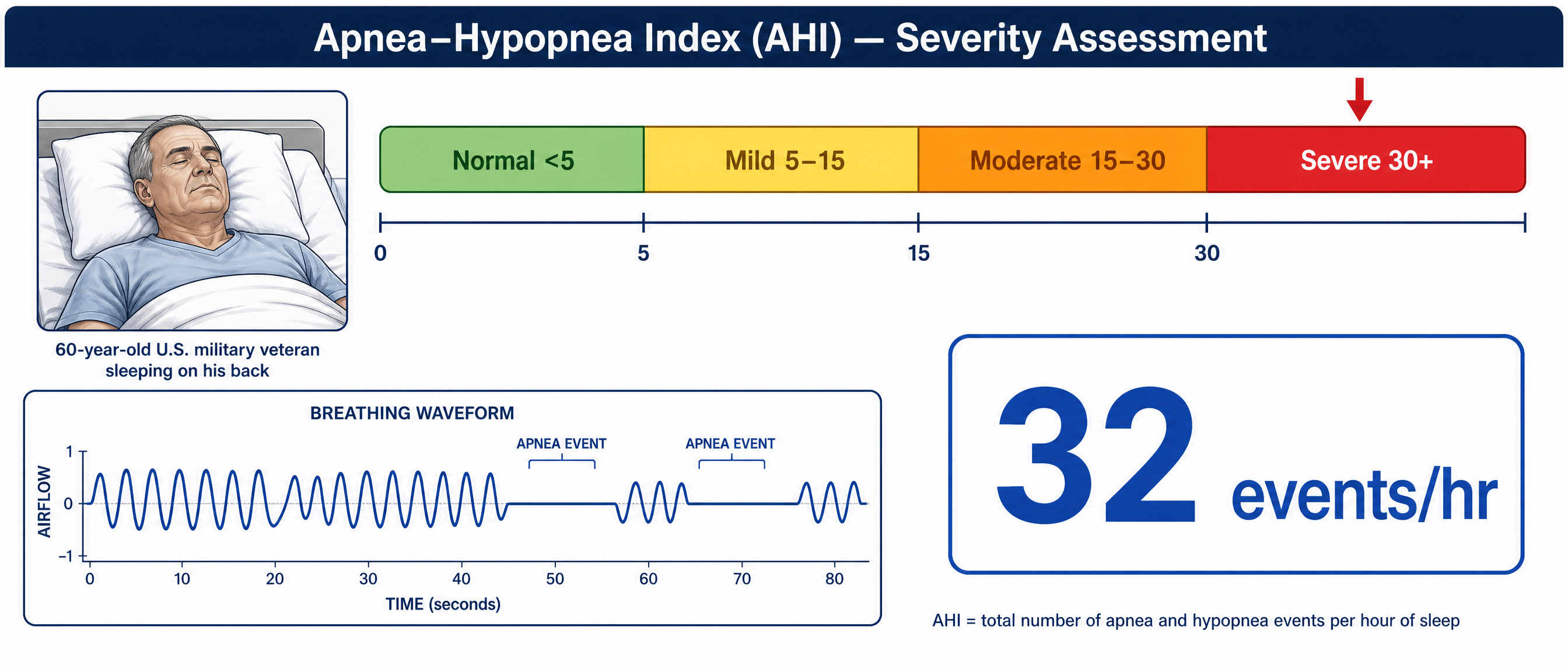 Clinical measurement diagram of the Apnea–Hypopnea Index severity scale, Normal under 5, Mild 5–15, Moderate 15–30, Severe 30 and above, with a marker in the severe zone and an inset of an older veteran asleep with a labeled breathing waveform