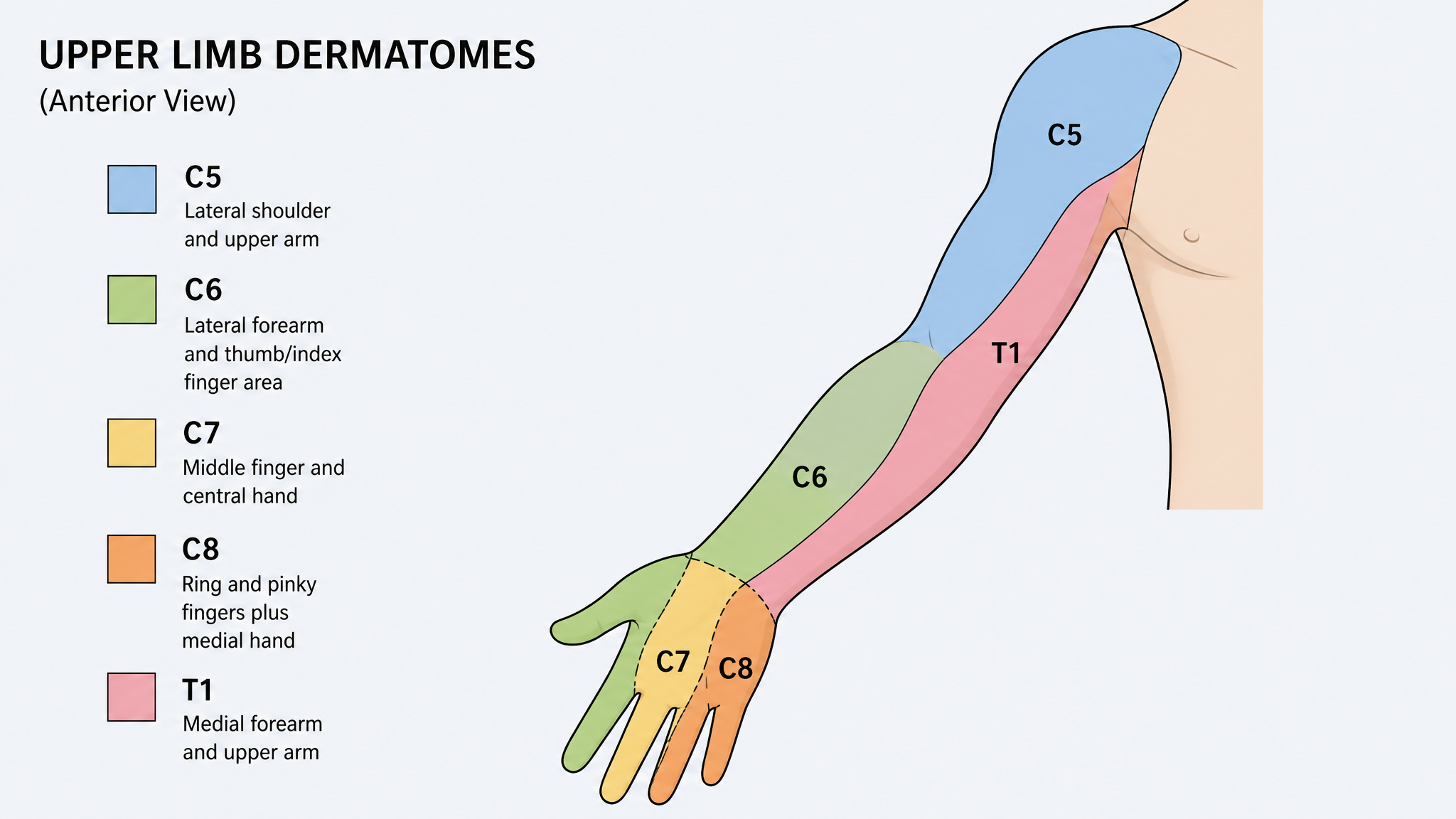 Clinical dermatome map of the arm and hand with the C5, C6, C7, C8 and T1 skin territories shown as separate labeled colored bands