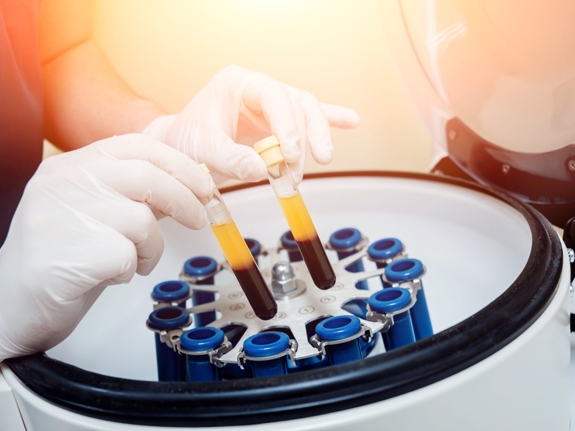 PRP Treatments at Precision Health & Wellness