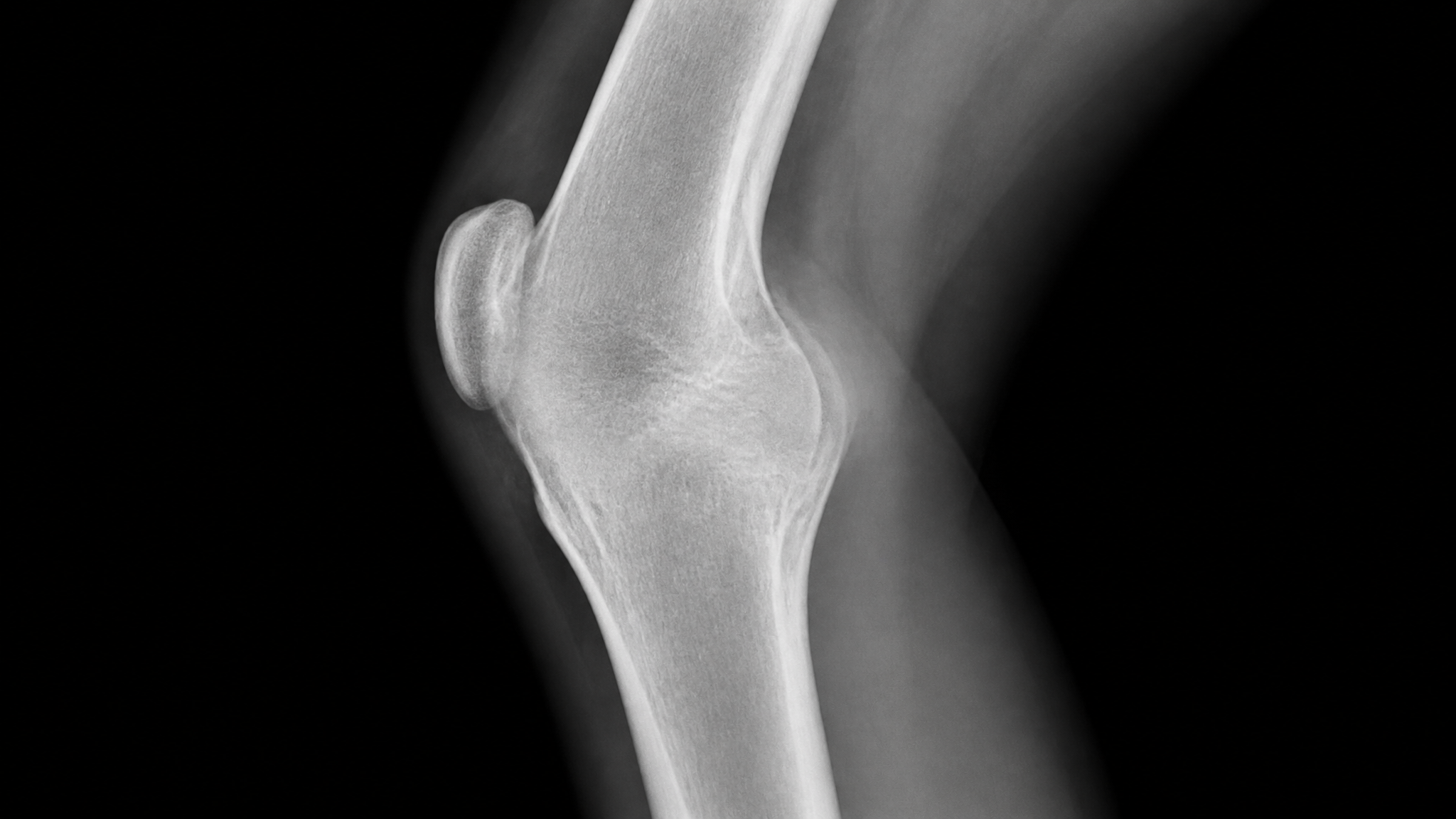 A clean knee X-ray showing a solidly bone-fused knee joint with no visible joint space